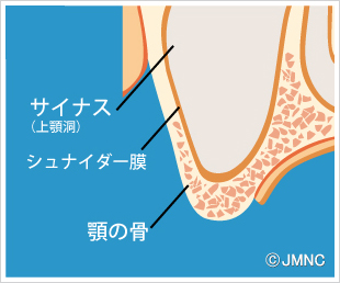 サイナスリフト