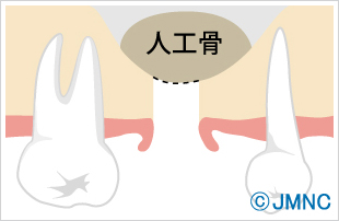 ソケットリフト