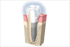 インプラント